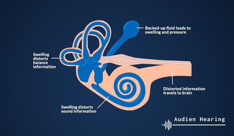 Neurological Tinnitus