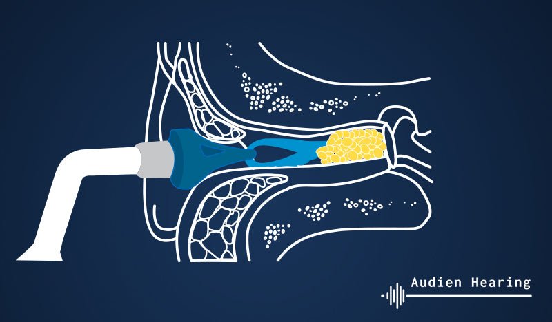 Earwax & Tinnitus