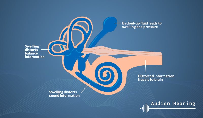 Meniere's Disease and Tinnitus