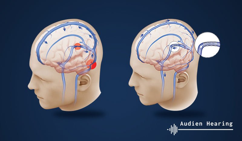 Surgery for Tinnitus